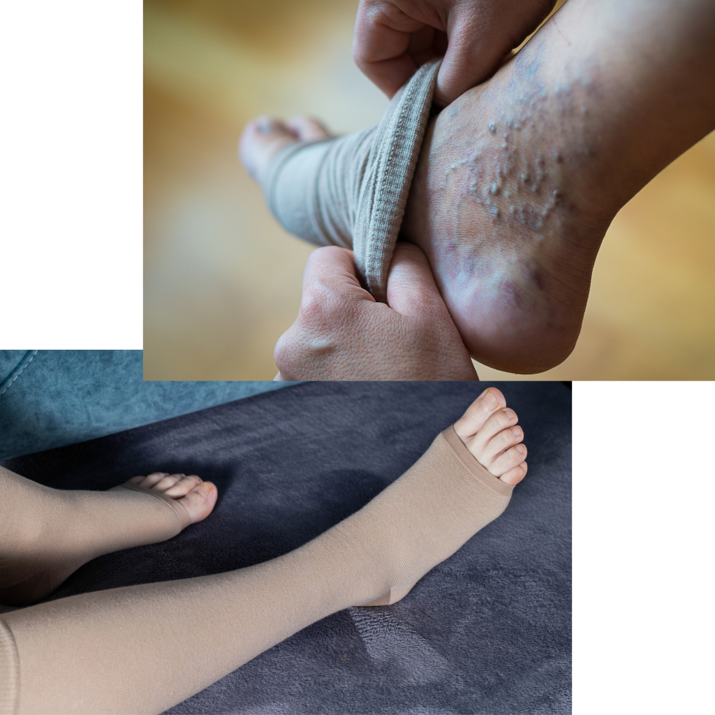 kompresijske nogavice na nogah s kroničnim venskim popuščanjem (KPV)