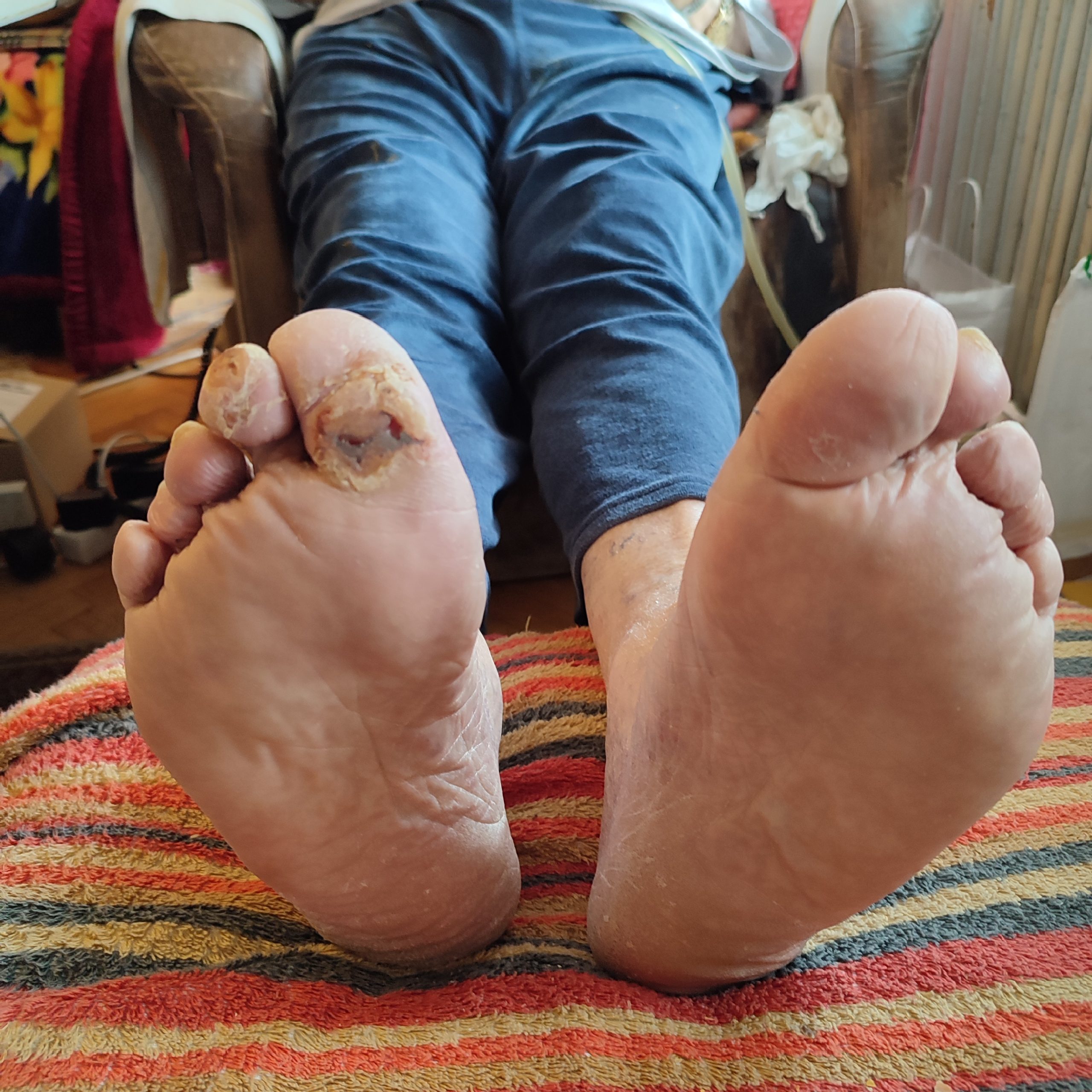 Diabetična stopala pred opravljeno suho pedikuro.